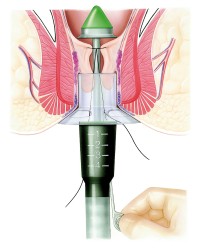 Oberhalb der Hämorrhoiden wird mit einem Klammernahtgerät eine Gewebemanschette entfernt, die Hämorrhoiden werden wieder an Ihre normale Position hochgezogen.