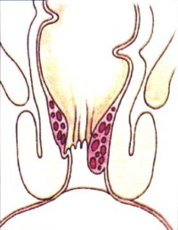 Beim zweitgradigen Hämorrhoidalleiden treten die Hämorrhoidalpolster beim Stuhlgang hervor, ziehen sich danach aber wieder zurück. Die Beschwerden nehmen insgesamt zu, eine Therapie mit Verödung, Abbindung (Ligatur), HAL oder Laser sind sinnvoll. Beim zweitgradigen Hämorrhoidalleiden treten die Hämorrhoidalpolster beim Stuhlgang hervor, ziehen sich danach aber wieder zurück. Die Beschwerden nehmen insgesamt zu, eine Therapie mit Verödung, Abbindung (Ligatur), HAL oder Laser sind sinnvoll.