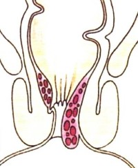 Das drittgradige Hämorhoidalleiden ist dadurch gekennzeichnet, daß der prolabierende Hämorrhoidalknoten vom Patienten zurückgeschoben werden muß, da er sich nicht mehr von selbst retrahiert. Leichte Inkontinenz, Ekzemneigung und Nachschmieren nehmen zu. Zur  Therapie kommt jetzt noch die Operation (Exzision, Anal lifting) zusätzlich zu den bereits genannten Optionen hinzu. Für die Laserbehandlung (LHP) ist dieses Stadium am Besten geeignet  