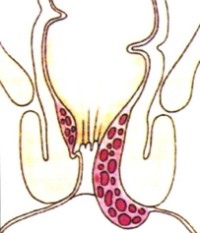 Beim viertgradigen Hämorrhoidalleiden ist das Hämorrhoidalpolster immer draußen. Sie können gar nicht (im akuten Stadium 4) oder nur kurz zurückgeschoben werden. Bei akuter Schwellung sollte zunächst konservativ vorgegangen werden, im chronischen, schmerzlosen Fall ist immer eine operative Maßnahme (meist Exzision mit Rekonstruktion oder Anal lifting wenn möglich) indiziert